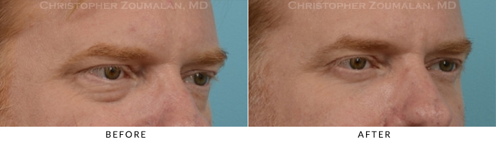 Male Blepharoplasty Before & After Photo -  - Patient 37
