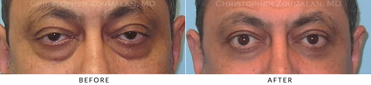 Male Blepharoplasty Before & After Photo -  - Patient 38