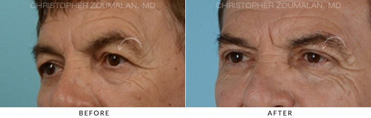 Male Blepharoplasty Before & After Photo - Patient Seeing Side - Patient 3A