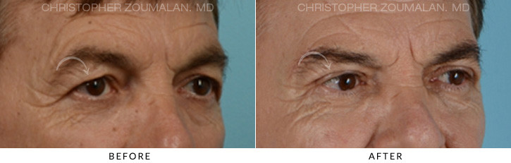 Male Blepharoplasty Before & After Photo - Patient Seeing Side - Patient 6B