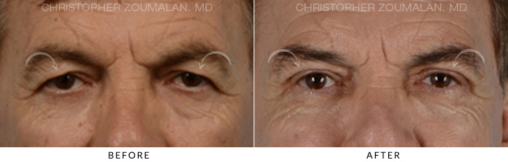Male Blepharoplasty Before & After Photo - Patient Seeing Straight - Patient 8C