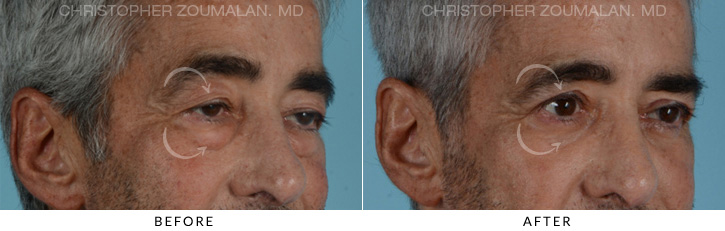 Male Blepharoplasty Before & After Photo - Patient Seeing Side - Patient 4A