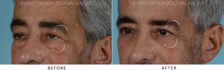 Male Blepharoplasty Before & After Photo - Patient Seeing Side - Patient 9B