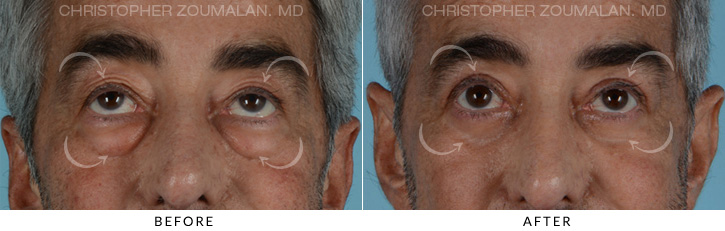 Male Blepharoplasty Before & After Photo - Patient Seeing Up - Patient 9C