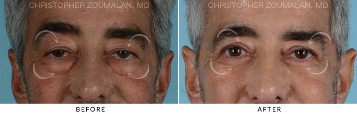 Male Blepharoplasty Before & After Photo - Patient Seeing Straight - Patient 9D