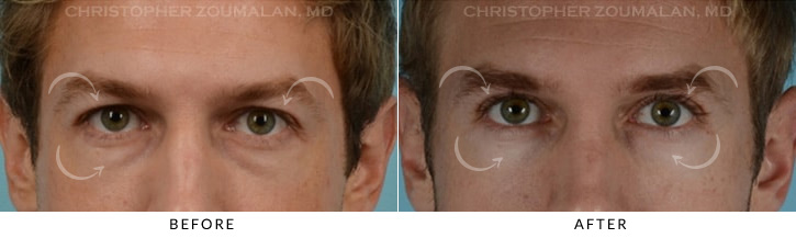 Male Blepharoplasty Before & After Photo - Patient Seeing Straight - Patient 10A
