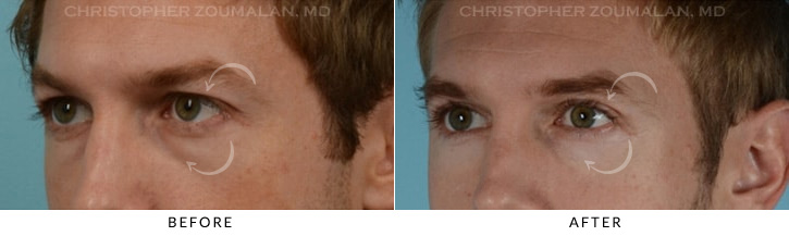 Male Blepharoplasty Before & After Photo - Patient Seeing Side - Patient 10B