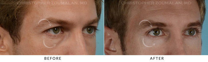 Male Blepharoplasty Before & After Photo - Patient Seeing Side - Patient 10C