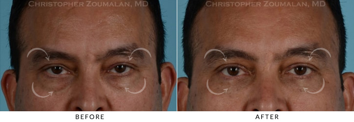 Male Blepharoplasty Before & After Photo - Patient Seeing Straight - Patient 11A