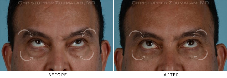Male Blepharoplasty Before & After Photo - Patient Seeing Up - Patient 6B