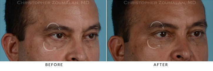 Male Blepharoplasty Before & After Photo - Patient Seeing Side - Patient 6D