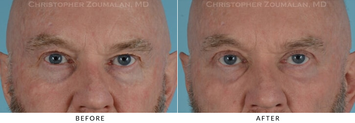 Male Blepharoplasty Before & After Photo - Patient Seeing Straight - Patient 12A