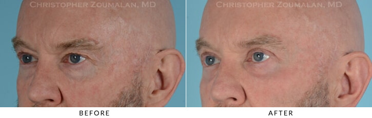 Male Blepharoplasty Before & After Photo - Patient Seeing Side - Patient 12B