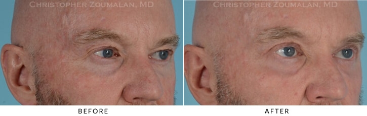 Male Blepharoplasty Before & After Photo - Patient Seeing Side - Patient 12C