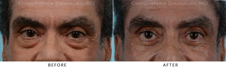 Male Blepharoplasty Before & After Photo - Patient Seeing Straight - Patient 14A