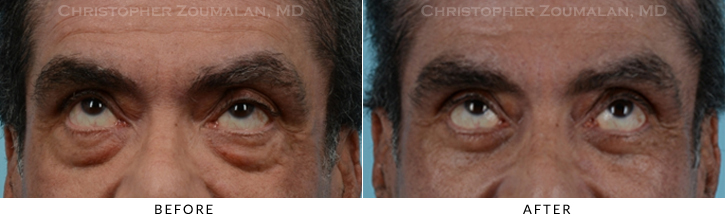 Male Blepharoplasty Before & After Photo - Patient Seeing Up - Patient 14B