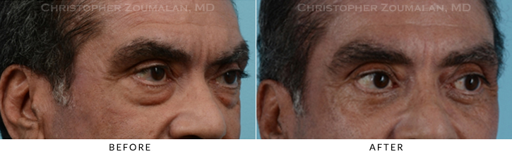 Male Blepharoplasty Before & After Photo - Patient Seeing Side - Patient 14C