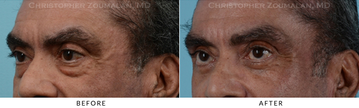 Male Blepharoplasty Before & After Photo - Patient Seeing Side - Patient 14D