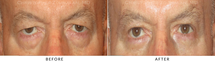 Male Brow Lift Before & After Photo -  - Patient 11