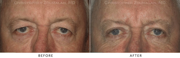 Male Brow Lift Before & After Photo -  - Patient 12