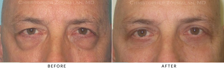 Male Brow Lift Before & After Photo -  - Patient 13