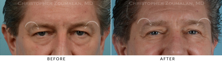 Male Brow Lift Before & After Photo -  - Patient 1