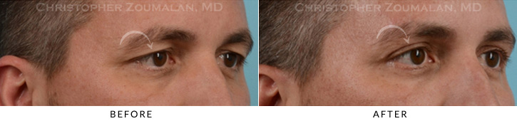 Male Brow Lift Before & After Photo - Patient Seeing Side - Patient 3A