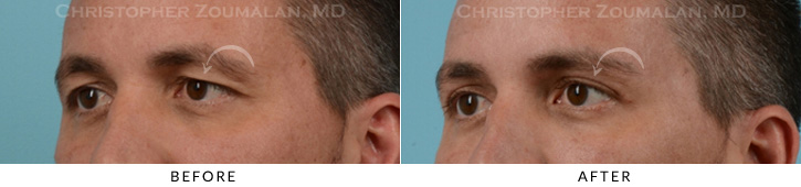 Male Brow Lift Before & After Photo - Patient Seeing Side - Patient 3B