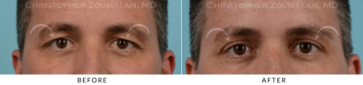 Male Brow Lift Before & After Photo - Patient Seeing Straight - Patient 3C