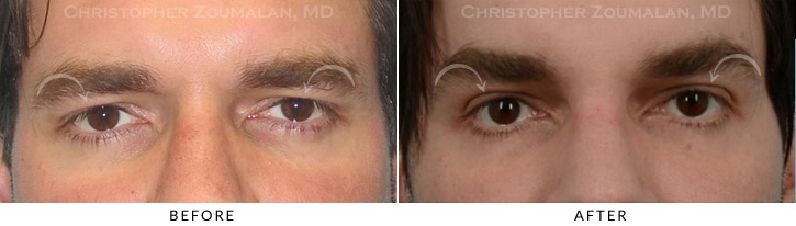 Male Brow Lift Before & After Photo -  - Patient 2