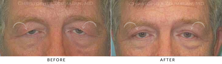 Male Brow Lift Before & After Photo -  - Patient 5