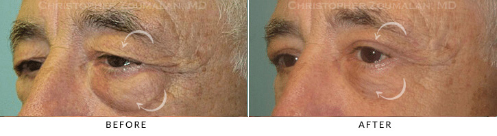 Male Brow Lift Before & After Photo - Patient Seeing Side - Patient 6B