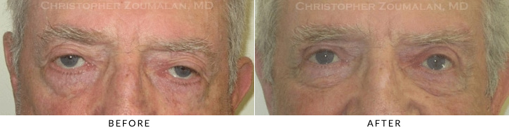 Male Brow Lift Before & After Photo -  - Patient 7