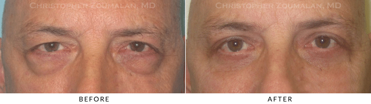 Male Brow Lift Before & After Photo -  - Patient 8
