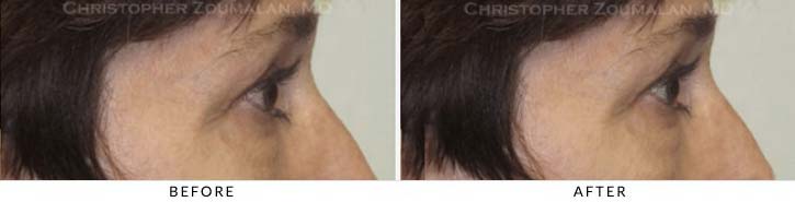 Midface Lift Before & After Photo - Patient Seeing Side - Patient 1C