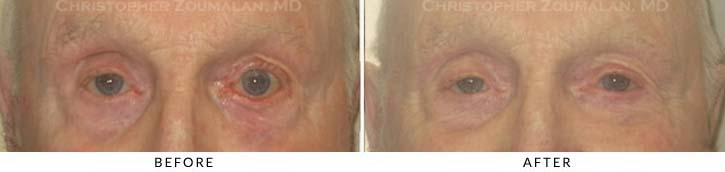 Midface Lift Before & After Photo - Patient Seeing Straight - Patient 2