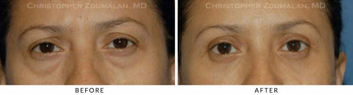 Midface Lift Before & After Photo - Patient Seeing Straight - Patient 7