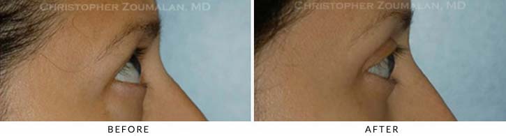 Midface Lift Before & After Photo - Patient Seeing Side - Patient 8
