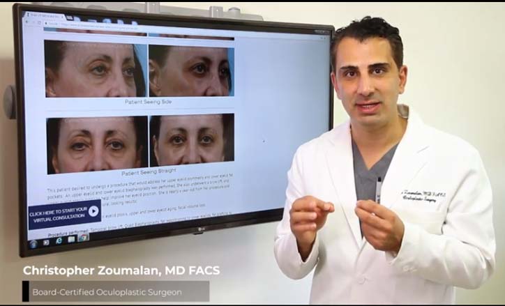 Natural Looking Blepharoplasty Technique- Click to view the Video