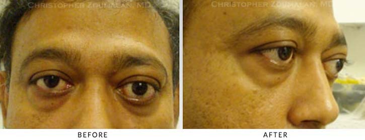 Orbital Decompression Before & After Photo -  - Patient 1A