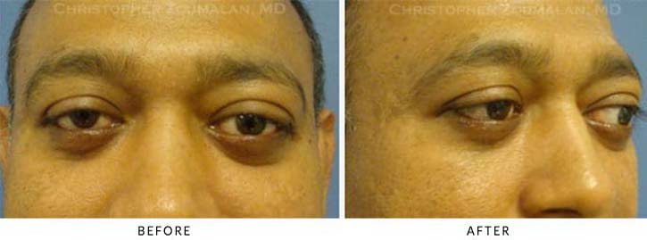 Orbital Decompression Before & After Photo -  - Patient 1C