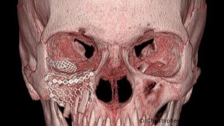 3D CT Reconstruction