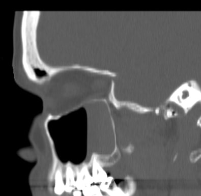 postopnormalleft-sagittal