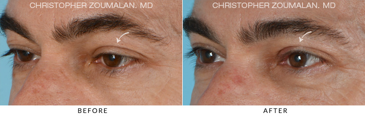Ptosis Surgery Before & After Photo - PATIENT SEEING SIDE - Patient 1B