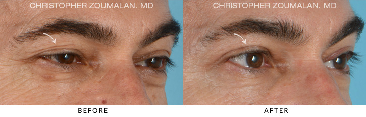 Ptosis Surgery Before & After Photo - PATIENT SEEING SIDE - Patient 1C
