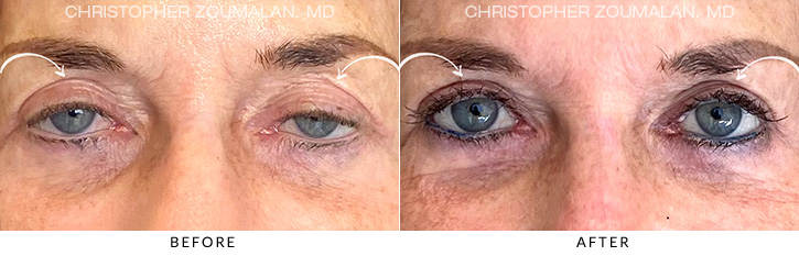 Ptosis Surgery Before & After Photo -  - Patient 3