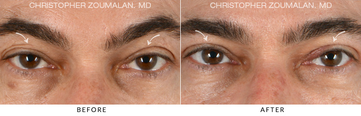 Ptosis Surgery Before & After Photo - PATIENT SEEING STRAIGHT - Patient 1A