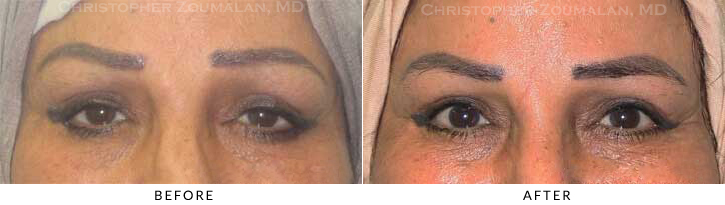 Ptosis Surgery Before & After Photo -  - Patient 17