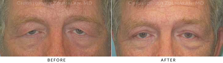 Ptosis Surgery Before & After Photo -  - Patient 16