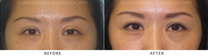 Ptosis Surgery Before & After Photo -  - Patient 18
